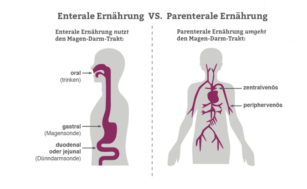 Parentale- vs enterale ernährung